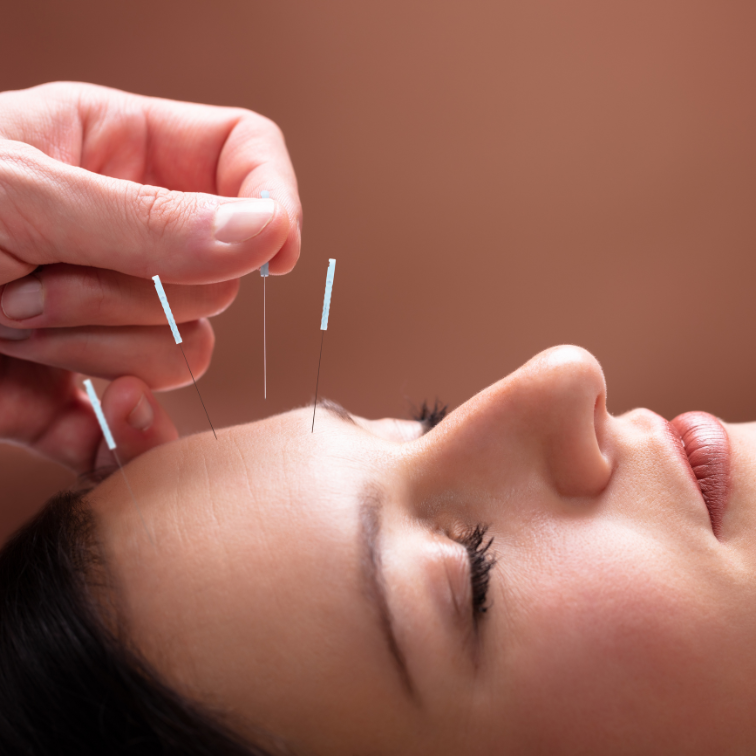 facial acupuncture brisbane